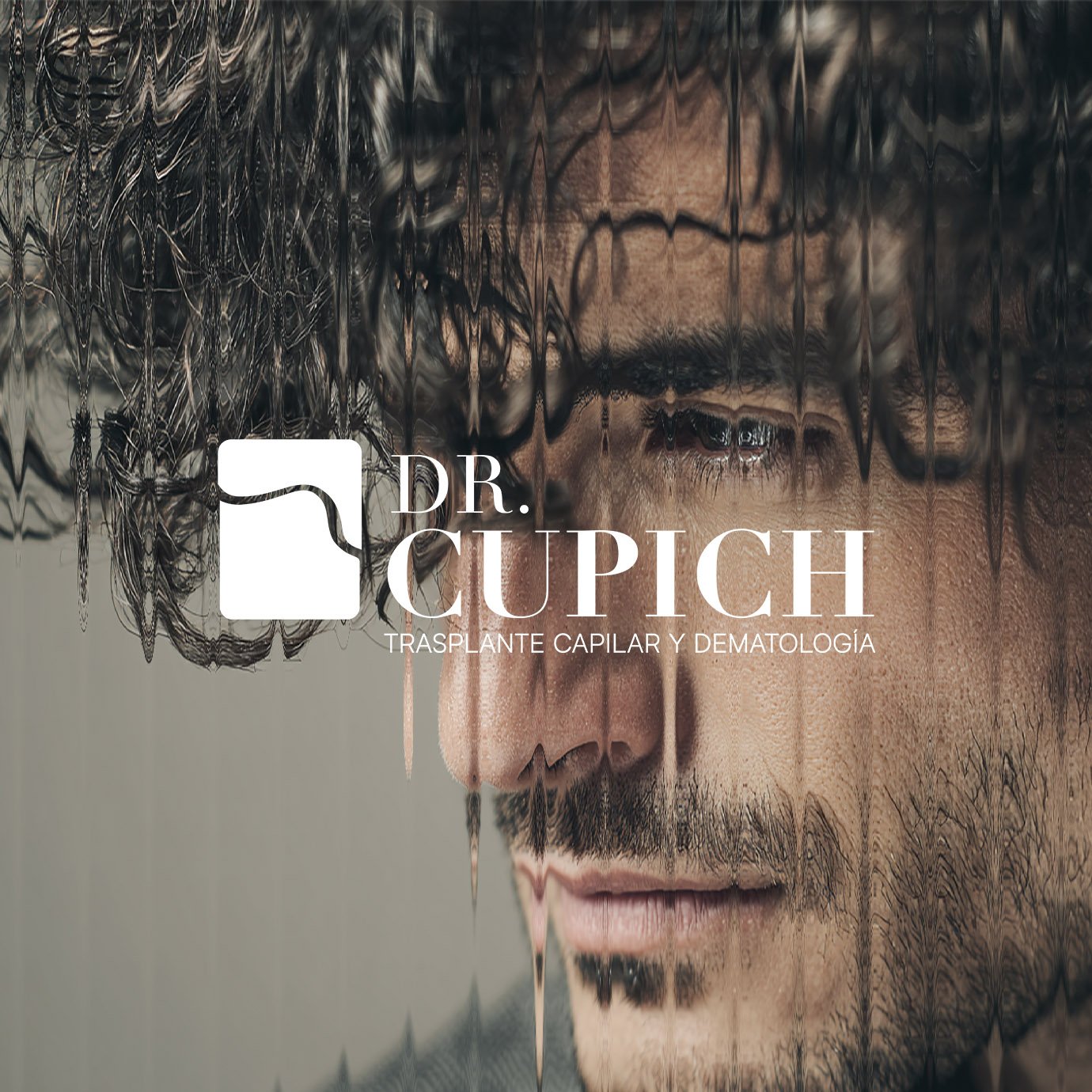 Trasplante Capilar
